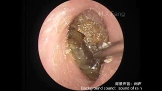 Ear wax and Dead skin removal耳垢和死皮清理20230821 [upl. by Nitsirc214]