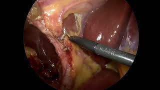 Laparoscopic cholecystectomy [upl. by Dick]