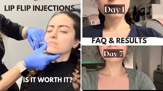 Lip flip botox injection  day by day comparison  FAQ amp results  everything you need to know [upl. by Ervin]