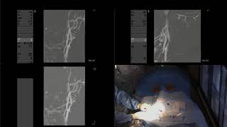 Balloon angioplasty and stenting of severe carotid stenosis [upl. by Auka]