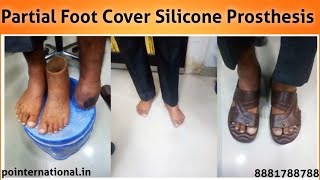 Partial Foot Cover Silicone Prosthesis  P amp O International Delhi  footprosthesis [upl. by Ardy]