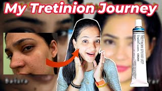 How RetinolTretinoin Transformed my Skin in just 2 Months A MustSee Indian YouTuber Anmol [upl. by Paolo347]