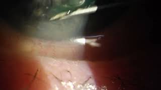 Eye Needle for Recurrent Corneal Erosion RCE [upl. by Fadas]