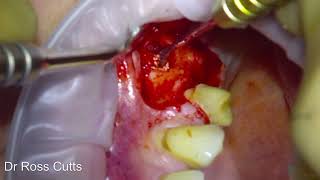 Straumann BLX implant placement and Simultaneous Sinus lift procedure [upl. by Gnok150]