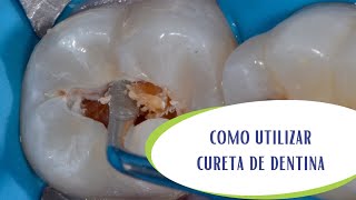 Como utilizar curetas de dentina [upl. by Anneh]