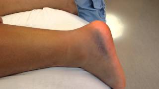 Quick test for Achilles tendon rupture [upl. by Niotna]