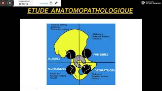 luxation traumatique de la hanche meilleure explication par Pr benfodda [upl. by Tnecnev]