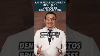 Irregularidades en rinoplastía  PlasticFacial MX [upl. by Aicak]