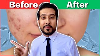 How to Get Rid of EVERY Type of Acne Scar  The Acne Scar ULTIMATE GUIDE [upl. by Lunn576]