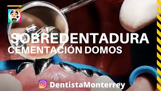 ⏭️ Cementación Domos 👅 SOBRE DENTADURA [upl. by Adnawot970]