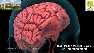 Ischemic Stroke Hindi  CIMS Hospital [upl. by Weasner]