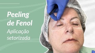 Peeling de Fenol  Aplicação setorizada  Dra Joise Wottrich [upl. by Bar]