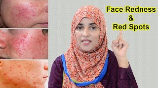 6 Remedies for Red Spots Face Redness amp Red Bumps  30 Days Skincare Guide Day 26 [upl. by Mcwherter437]