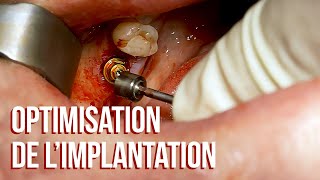 🦷 Nouveau protocole de pose dimplants [upl. by Pani]