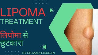 How to Treat Lipoma Lipoma Treatment  Best Doctor in kalkaji Delhi DrMadhusudan [upl. by Ehav]