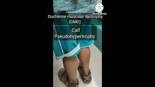 Duchenne muscular dystrophy DMD [upl. by Murat]