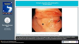 Ectopic ampulla with cholangitis A case report [upl. by Burt976]