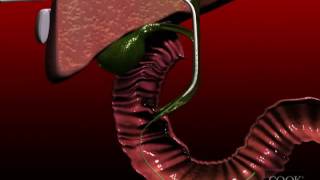 Biliary Drainage Catheter insertion animation [upl. by Obelia728]