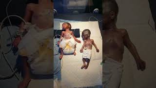 Twins  Twin Pregnancy  Babies in the womb  Multiple Pregnancy shortsfeed twins baby fyp [upl. by Ahcsatan]