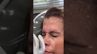 Botox for the glabella area It’s important to animate to see muscle movement prior to injecting [upl. by Leesa]