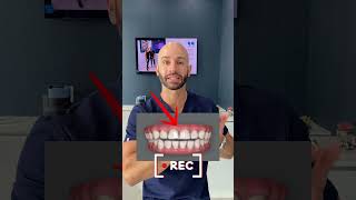 Deep Bite Correction with Invisalign 2024 [upl. by Aroda]