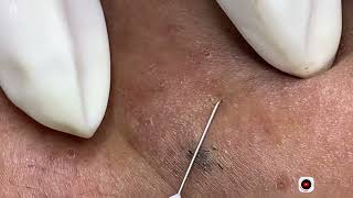 Big Cystic Acne Blackheads Extraction Blackheads amp Milia Whiteheads Removal Pimple Popping [upl. by Lodhia178]