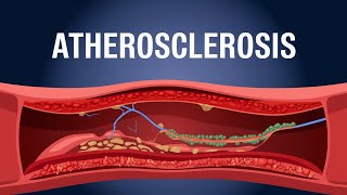 Atherosclerosis animation understanding Atherosclerosis [upl. by Anile]