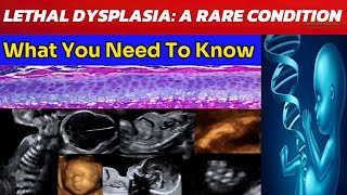 Lethal Skeletal Dysplasia Understanding a Rare Condition  What Every Parent Should Know [upl. by Nyletak]