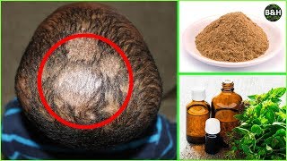 Ringworm Hair Loss Treatment  How To Get Rid of Scalp Fungus Instantly Tinea Capitis [upl. by Machute]