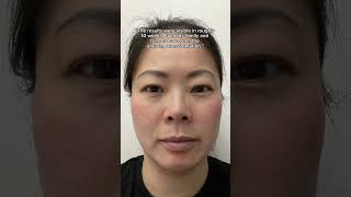 Mandys melasma journey [upl. by Enelyar]