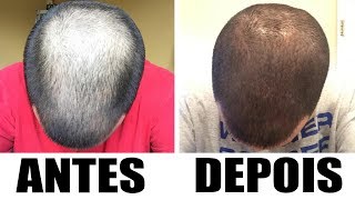 Evolução do tratamento  Antes e Depois  Minoxidil Kirkland  Cabelo  4 Meses [upl. by Spillar]