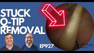 STUCK QTIP REMOVAL FROM EAR  EP927 [upl. by Arly]