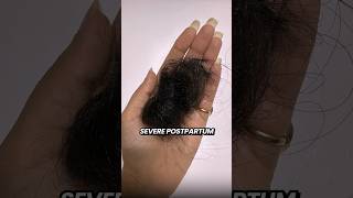 The Hair Growth Serum That Grew My Hair back hairgrowth hairfall hairfallsolution wishcare [upl. by Anrym]