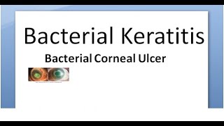 Ophthalmology 111 a Bacterial Keratitis Corneal Ulcer Cornea Bacteria Infective Hypopyon infection [upl. by Yenahs557]