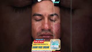 Do you know this melasma solution Remove melasma from 2 weeks melasmacream melasmatreatment [upl. by Wadesworth411]