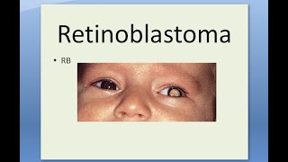 Pathology 509 a Retinoblastoma Eye Tumor Retina Child Flexner WinterSteiner Home Wright Rosette [upl. by Noni]