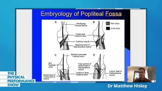 POPLITEAL ARTERY ENTRAPMENT SYNDROME 319 Dr Matthew Hislop Sport amp Exercise Medicine Physician [upl. by Zere]