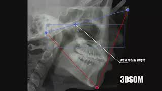 3DSOM ORTHODONTIC Non extraction case of Bimaxillary protrusion [upl. by Imit]