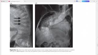 CLINICAL IMAGING OF SPINAL TRAUMA [upl. by Sundberg]