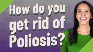 How do you get rid of Poliosis [upl. by Harald]