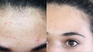 CUROLOGY REVIEW 2 YEARS LATER  Drugstore Skin Care Routine for Acne [upl. by Esenaj210]