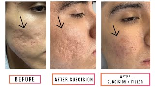 Subcision  Filler for Acne Scars [upl. by Derrej]