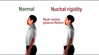 Nuchal rigidity  pathognomonic sign of meningeal irritation [upl. by Atiuqihs]