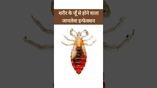 शरीर का जूँ  Body Lice  जानलेवा साबित हो सकता है इससे होने वाला इन्फेक्शन  Pediculosis Corporis [upl. by Zsuedat950]