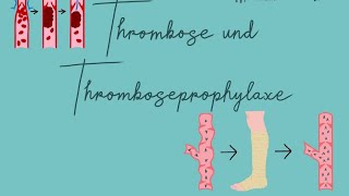 Thromboseprophylaxe Examensfrage [upl. by Otrebcire729]