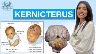 What is KERNICTERUS  How it’s caused  How it affects your body …amp everything you need to know [upl. by Launamme]