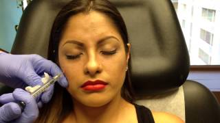 Botox amp Juvederm Voluma Injections for Young Women [upl. by Yenahpets]