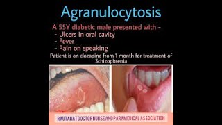 Agranulocytosis Symptoms and Causes  Diagnosis  Treatment  Prevention [upl. by Suirradal]