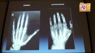 Diagnóstico por Imagen  Osteoporosis Osteopenia Osteomalacia y Esclerosis [upl. by Edasalof]