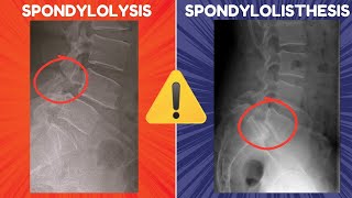 Spondylolysis vs Spondylolisthesis  Definitions Diagrams and Radiographic Appearances [upl. by Moulden188]